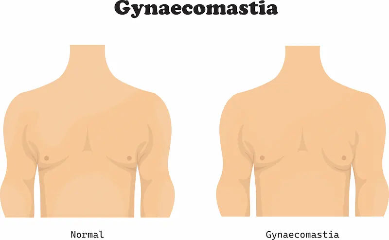 Gynecomastia Explained Causes, Symptoms, Treatment